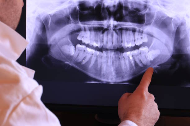 Best Knocked-Out Tooth (Avulsed Tooth) Treatment in North Wales, PA